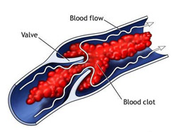thrombosis | Olive Oil Times